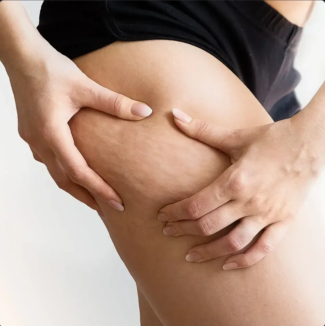 celulit menopavza, celulit po 50, GUAM masaža menopavza, kolagen menopavza, celulit hormonske spremembe